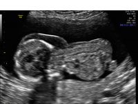 Cystic hygroma sagittal